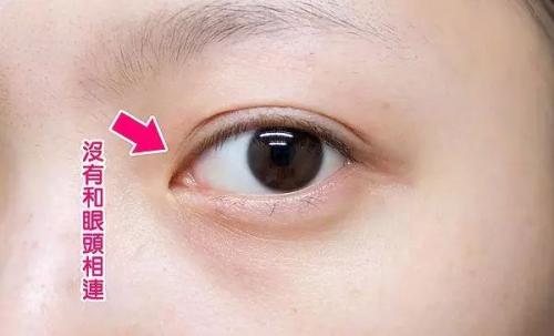 韩式三点双眼皮的优势有哪些