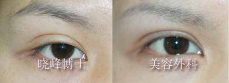 双眼皮修复