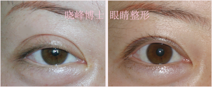 双眼皮下垂修复