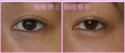 埋线双眼皮修复