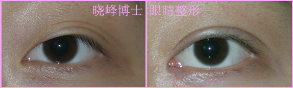 双眼皮修复案例