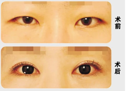 开内眼角手术后吃水果，割双眼皮，开内眼角后，开眼角的效果，