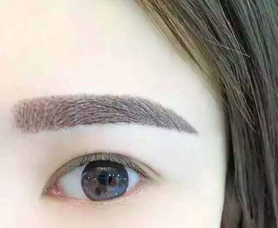 武汉切眉术需要多少钱,切眉的方式,切眉效果,上睑皮肤松弛,切眉方法