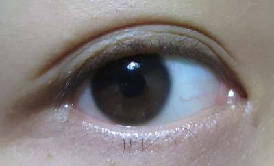 埋线双眼皮手术的安全性