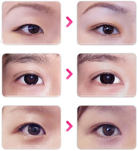 埋线双眼皮的副作用