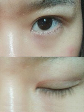 埋线双眼皮术前的注意事项