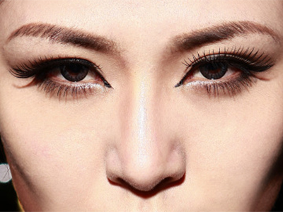 埋线双眼皮的手术效果