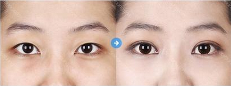 埋线双眼皮手术后的效果