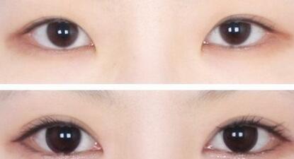 埋线双眼皮的恢复时间,切开法双眼皮手术