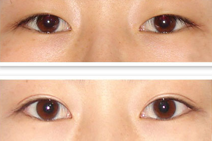 切开双眼皮副作用表现