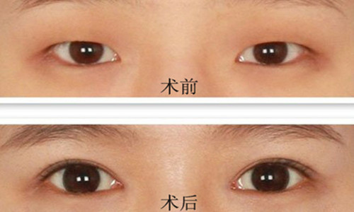 切开双眼皮的优点