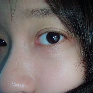 切开双眼皮的后遗症表现