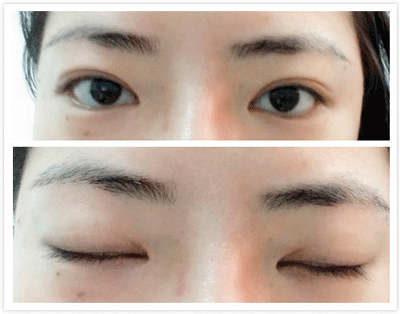 切开双眼皮的手术效果