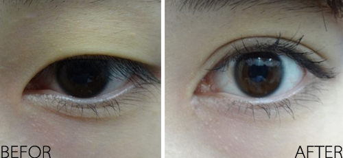 天津切开双眼皮的价格