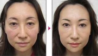 激光祛眼袋的安全性