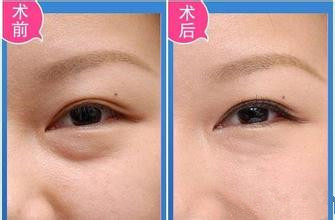 吸脂祛眼袋的特点