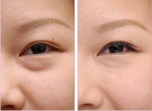 吸脂祛眼袋的安全性