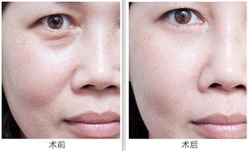 吸脂祛眼袋手术前要注意什么