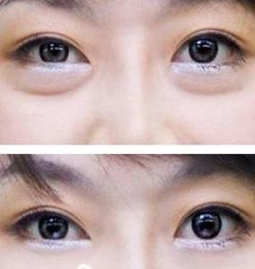 吸脂祛眼袋的副作用