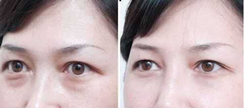 吸脂祛眼袋的风险