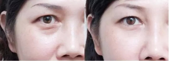 激光去眼袋手术后的恢复时间