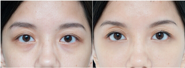 吸脂去眼袋的优点有哪些