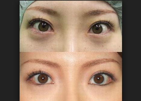 开眼角手术后的注意事项