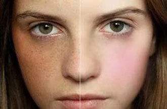 镭射祛斑多少钱,激光激光去雀斑做一次价格,雀斑大概要花多少钱