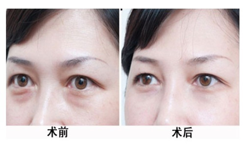 去除黑眼圈的有效方法