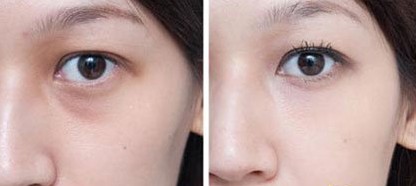 开眼角手术多久恢复期