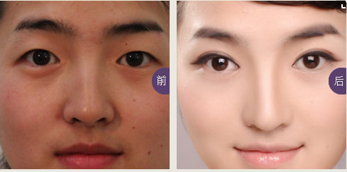 甘肃开眼角手术方法,割双眼皮,W开眼角方法,开眼角整形手术,横切开眼角方法优点,MUSTARDE开眼角方法,