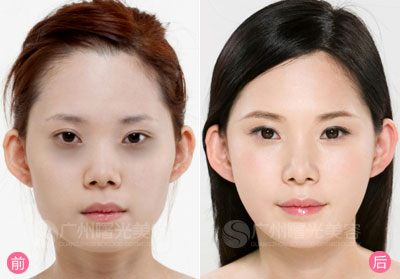 激光去除黑眼圈手术方法