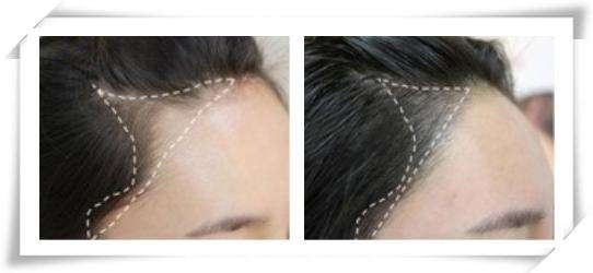 韩式半永久调整发际线多少钱,做韩式半永久发际线