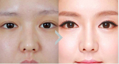 黑眼圈需要注意些什么