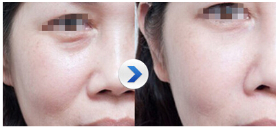 自体脂肪填充泪沟,自身的脂肪颗粒,自体脂肪填充泪沟会反弹吗，自体脂肪填充泪沟优势