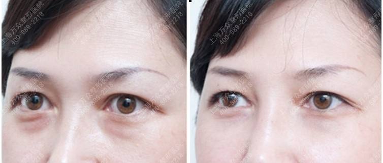 祛眼袋哪家医院好,激光去眼袋有什么好，激光去眼袋