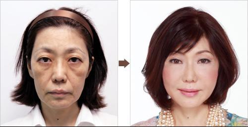 激光祛眼袋副作用,激光去眼袋的副作用,激光去眼袋价格多少钱