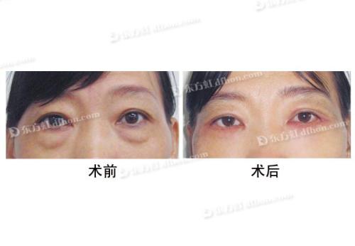 抽脂法祛眼袋安全吗,吸脂去眼袋安全吗,吸脂去眼袋好吗,吸脂去眼袋需要多少钱