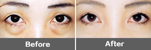 抽脂祛眼袋的优势,抽脂去眼袋,眼袋抽脂效果好吗,