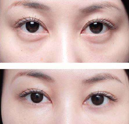 无痕去眼袋安全吗,无痕祛眼袋安全吗，祛眼袋手术效果如何，