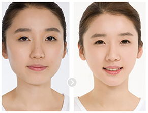 改脸型的优势是什么