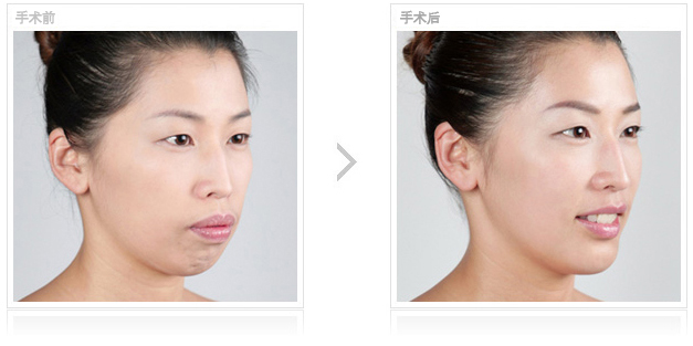 改脸型术后护理