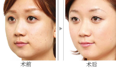 广东韩式改脸型安全吗