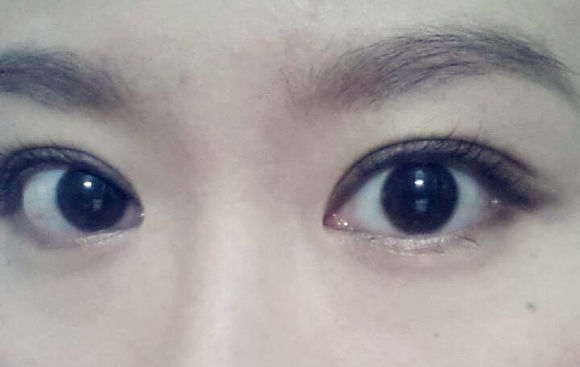 全切双眼皮手术