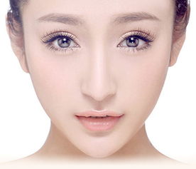 埋线双眼皮手术效果