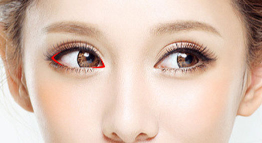 开外眼角的优缺点