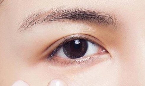 部分切开双眼皮