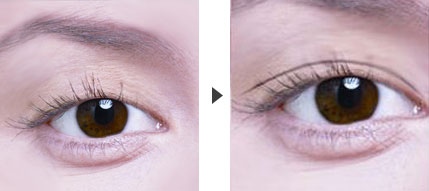 双眼皮可以维持多久时间,