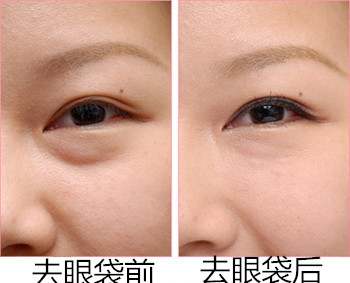 去眼袋手术的价格,去眼袋的手术方法有关,去眼袋手术价格大致多少,手术去眼袋的价格是多少