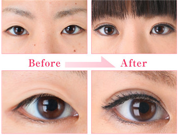 开内眼角会留疤吗